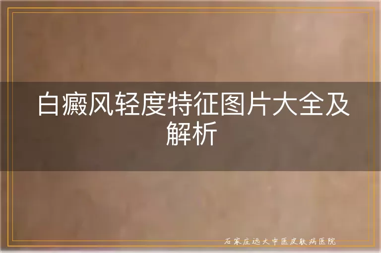 白癜风轻度特征图片大全及解析