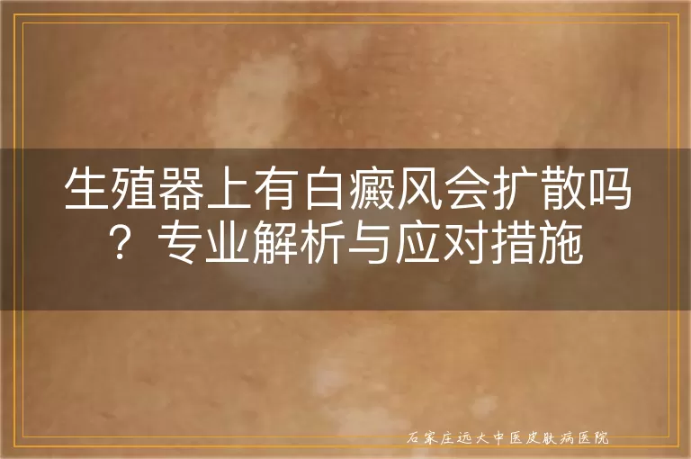 生殖器上有白癜风会扩散吗？专业解析与应对措施