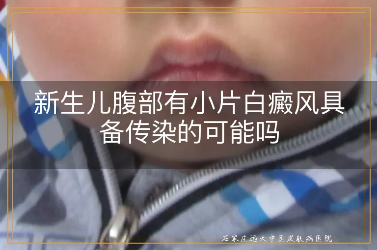 新生儿腹部有小片白癜风具备传染的可能吗