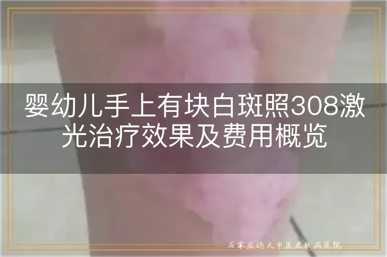 婴幼儿手上有块白斑照308激光治疗效果及费用概览