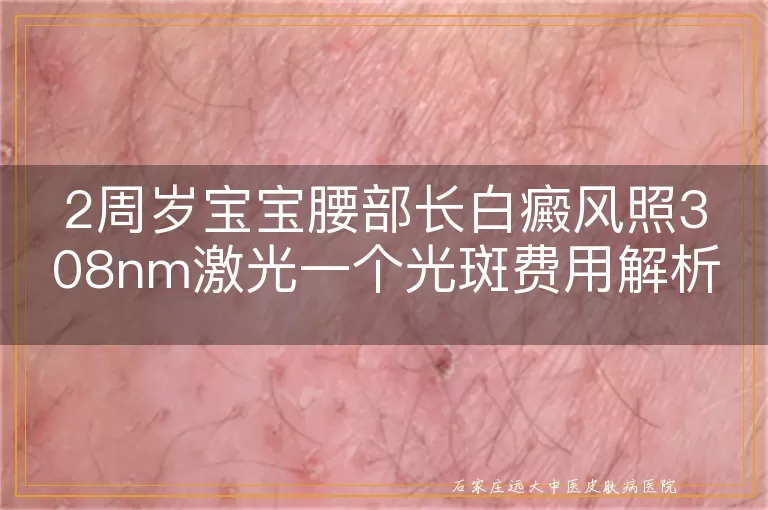 2周岁宝宝腰部长白癜风照308nm激光一个光斑费用解析