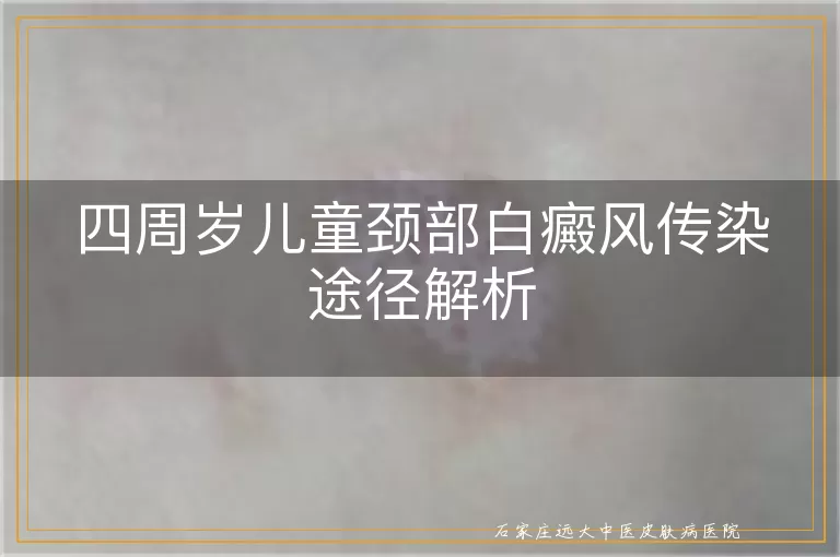 四周岁儿童颈部白癜风传染途径解析