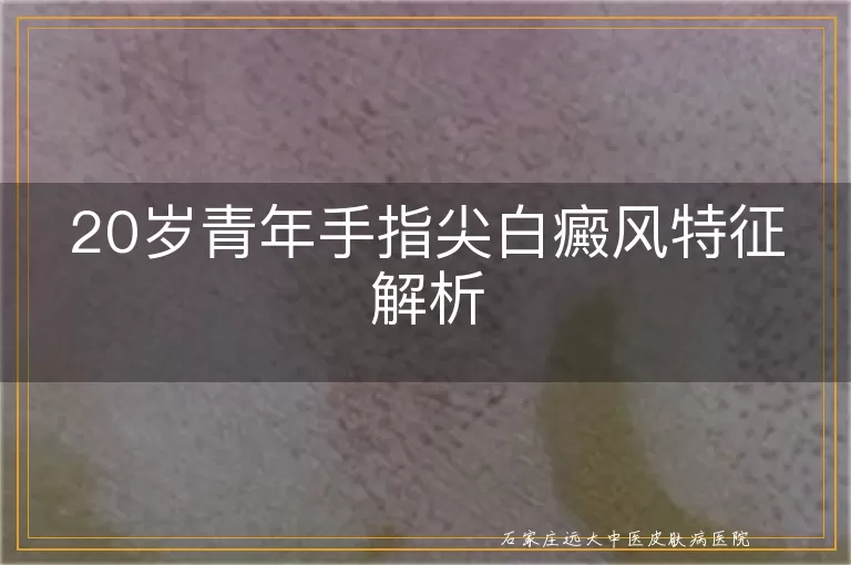 20岁青年手指尖白癜风特征解析