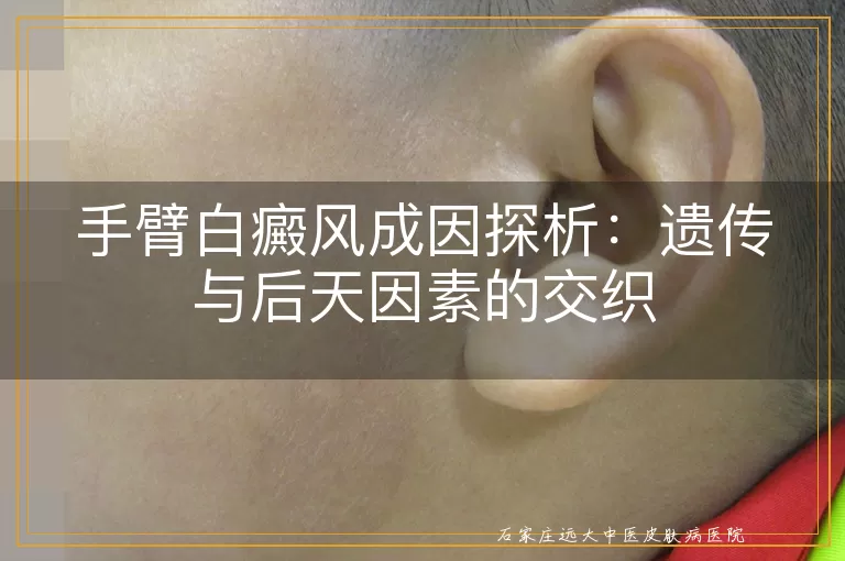 手臂白癜风成因探析：遗传与后天因素的交织