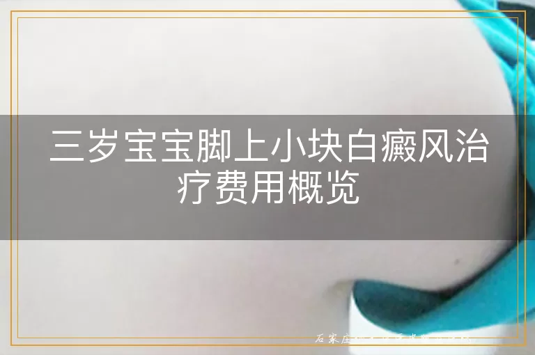 三岁宝宝脚上小块白癜风治疗费用概览
