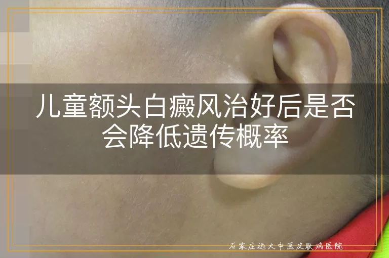 儿童额头白癜风治好后是否会降低遗传概率