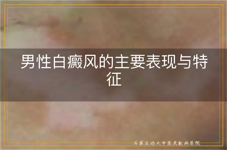 男性白癜风的主要表现与特征