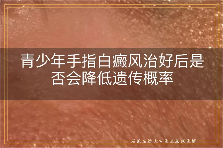 青少年手指白癜风治好后是否会降低遗传概率