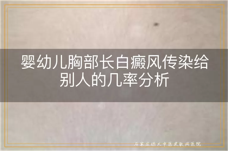 婴幼儿胸部长白癜风传染给别人的几率分析