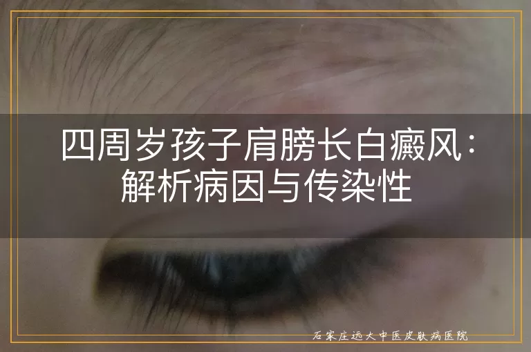 四周岁孩子肩膀长白癜风:解析病因与传染性