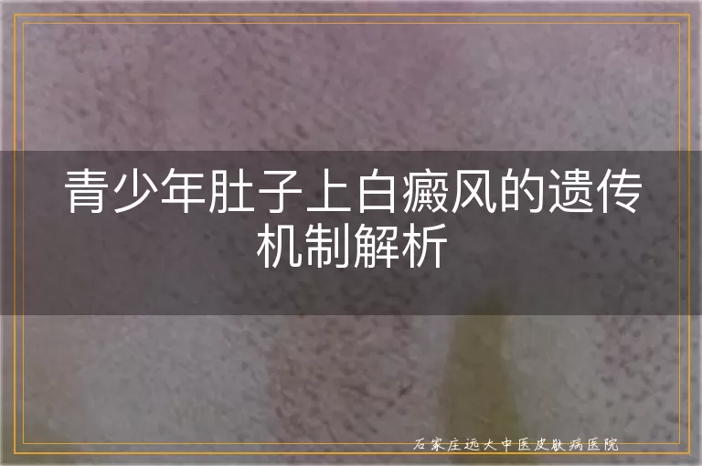 青少年肚子上白癜风的遗传机制解析