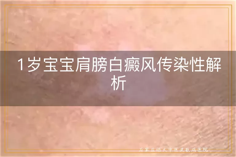 1岁宝宝肩膀白癜风传染性解析