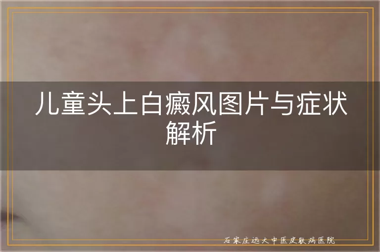 儿童头上白癜风图片与症状解析