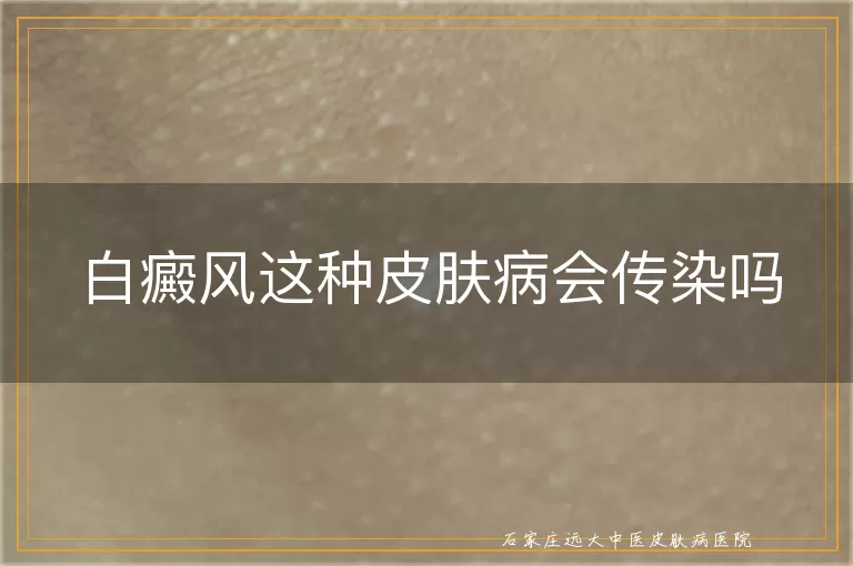 白癜风这种皮肤病会传染吗