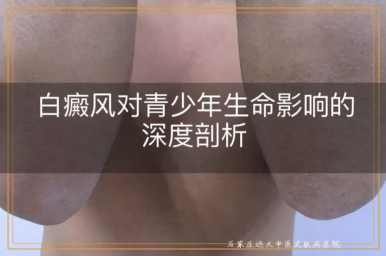 白癜风对青少年生命影响的深度剖析
