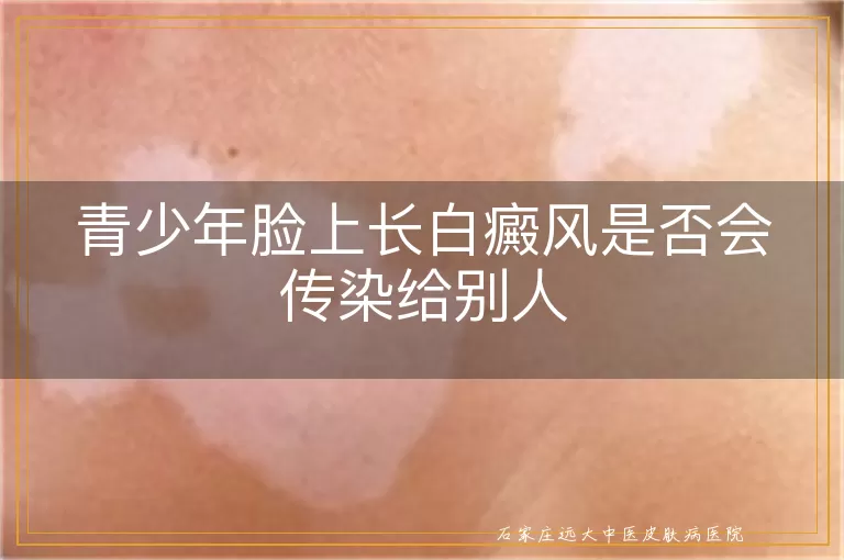 青少年脸上长白癜风是否会传染给别人