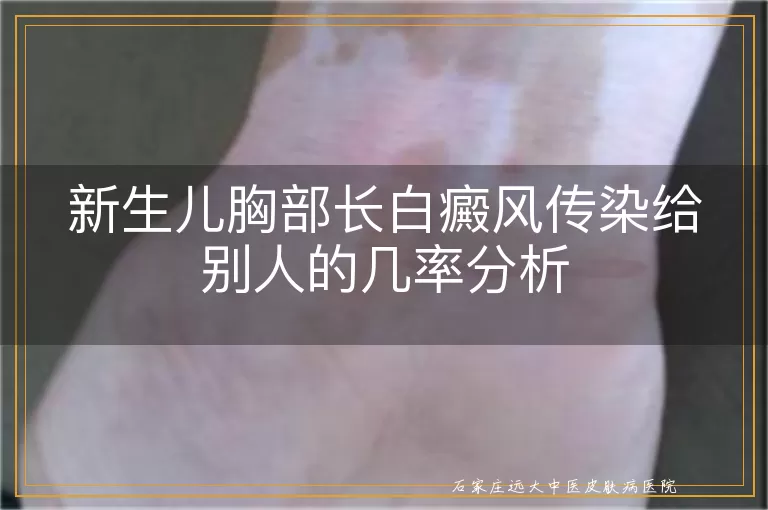 新生儿胸部长白癜风传染给别人的几率分析