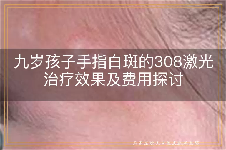 九岁孩子手指白斑的308激光治疗效果及费用探讨