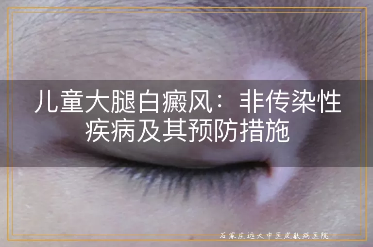 儿童大腿白癜风：非传染性疾病及其预防措施