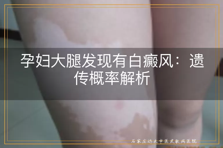 孕妇大腿发现有白癜风：遗传概率解析
