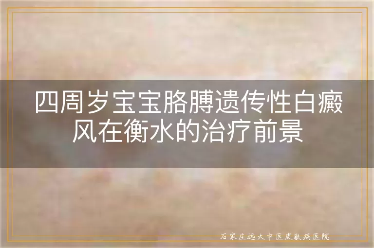 四周岁宝宝胳膊遗传性白癜风在衡水的治疗前景