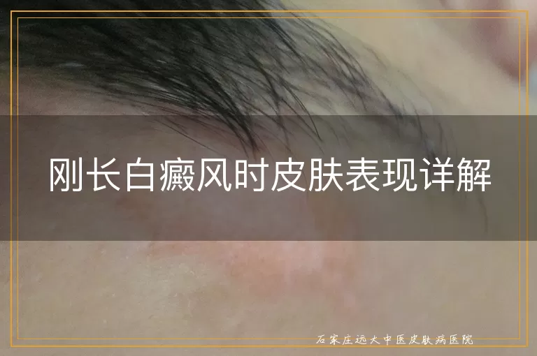 刚长白癜风时皮肤表现详解