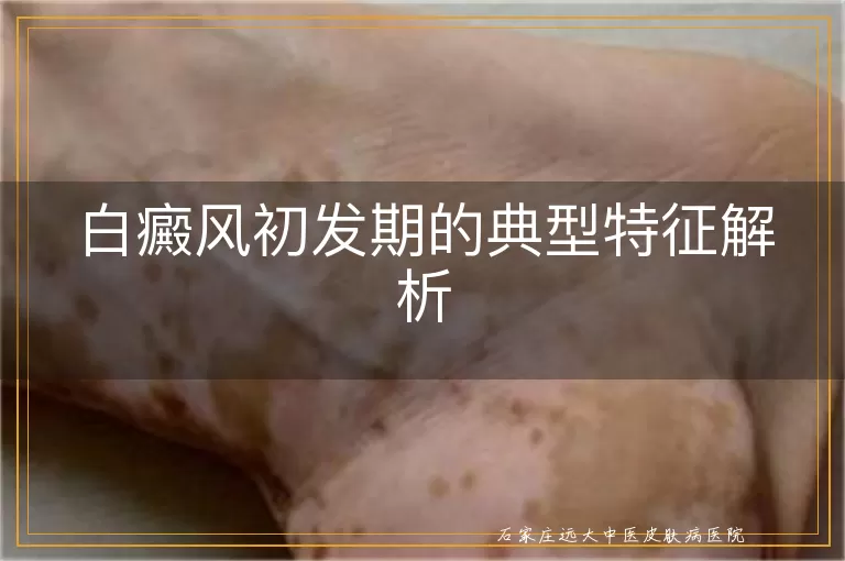 白癜风初发期的典型特征解析