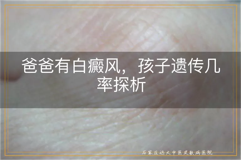 爸爸有白癜风，孩子遗传几率探析