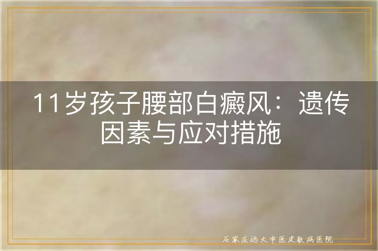 11岁孩子腰部白癜风：遗传因素与应对措施