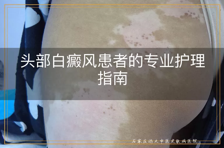 头部白癜风患者的专业护理指南