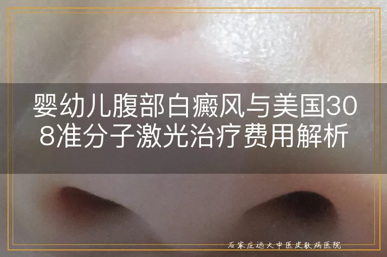 婴幼儿腹部白癜风与美国308准分子激光治疗费用解析