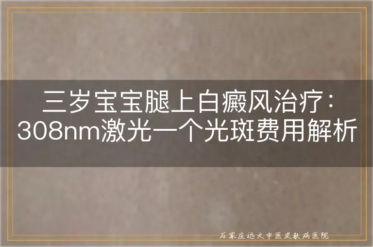 三岁宝宝腿上白癜风治疗：308nm激光一个光斑费用解析