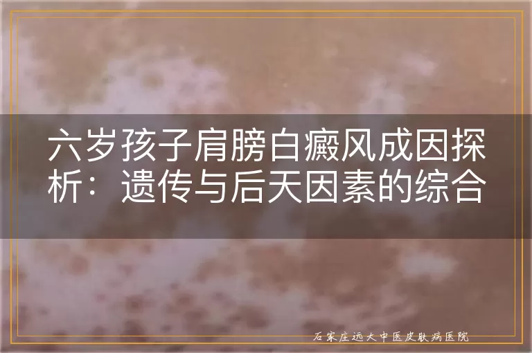六岁孩子肩膀白癜风成因探析：遗传与后天因素的综合考量