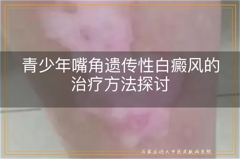 青少年嘴角遗传性白癜风的治疗方法探讨