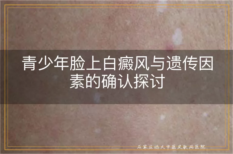 青少年脸上白癜风与遗传因素的确认探讨