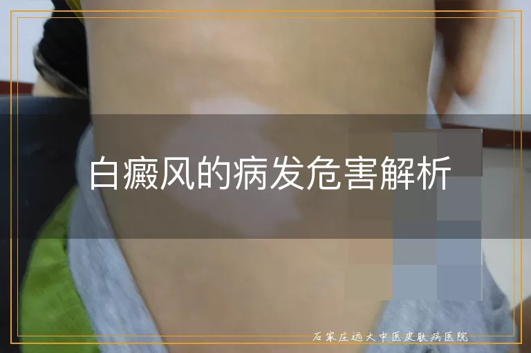 白癜风的病发危害解析