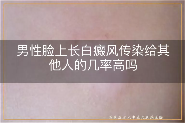 男性脸上长白癜风传染给其他人的几率高吗