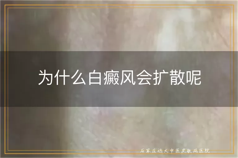 为什么白癜风会扩散呢