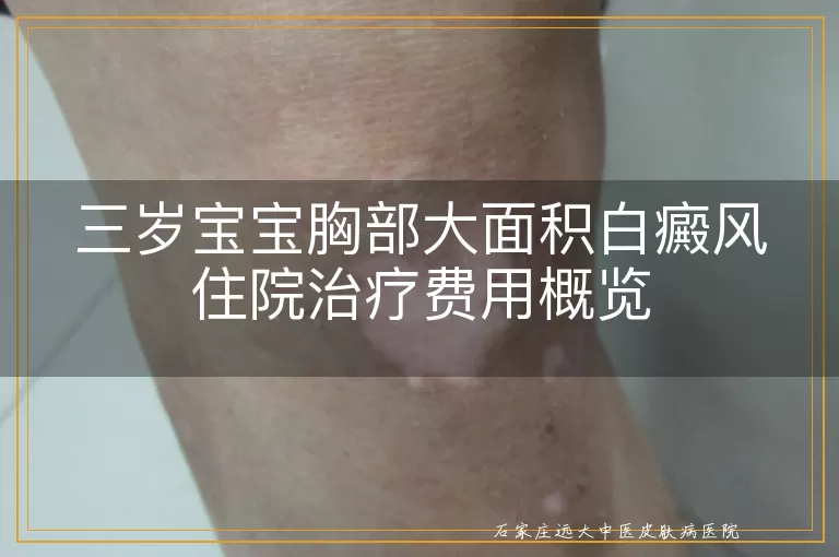 三岁宝宝胸部大面积白癜风住院治疗费用概览