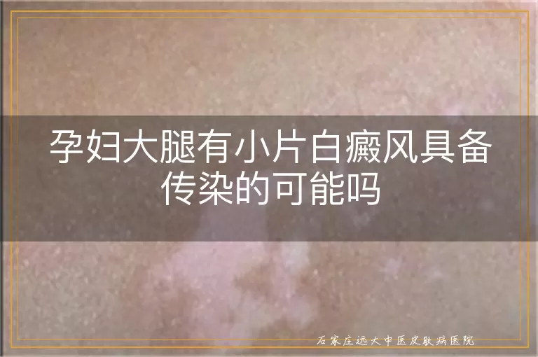 孕妇大腿有小片白癜风具备传染的可能吗