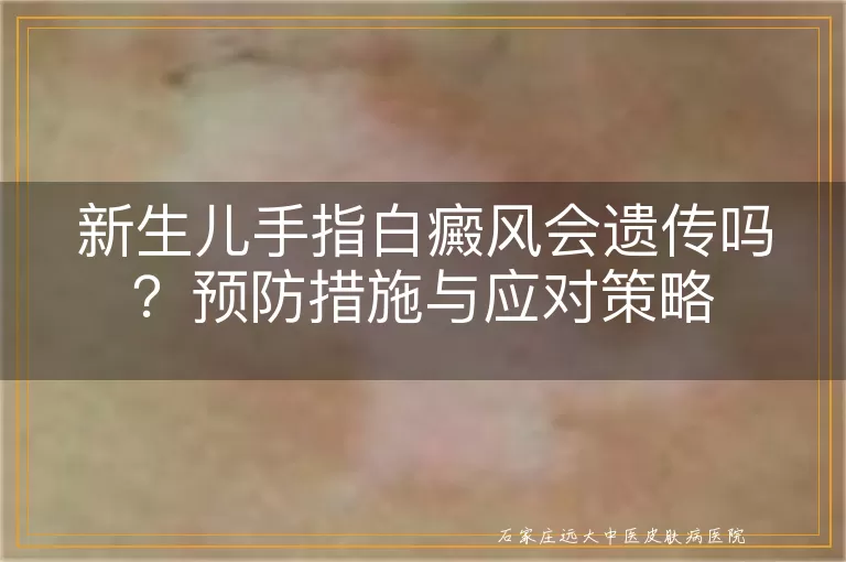 新生儿手指白癜风会遗传吗？预防措施与应对策略