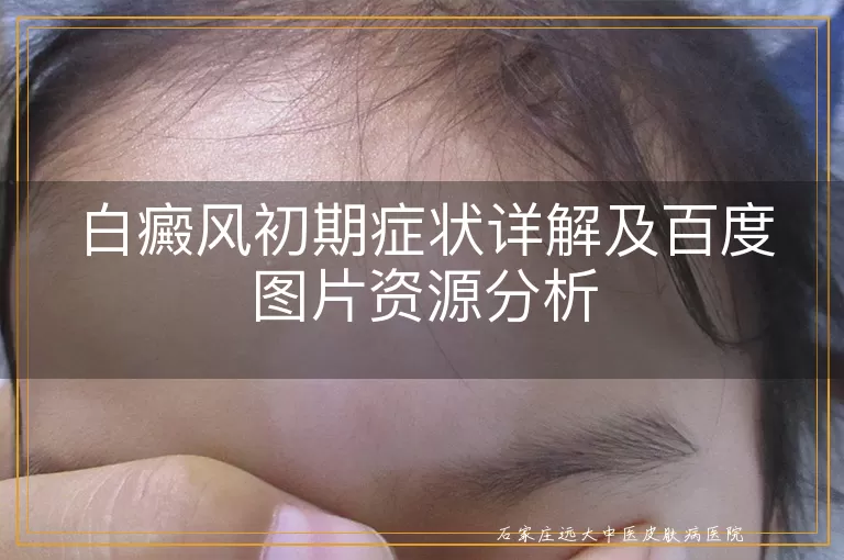 白癜风初期症状详解及百度图片资源分析