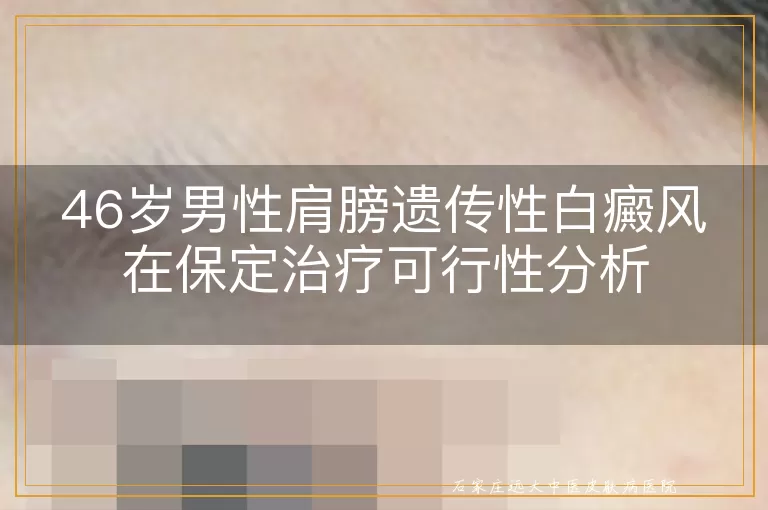 46岁男性肩膀遗传性白癜风在保定治疗可行性分析