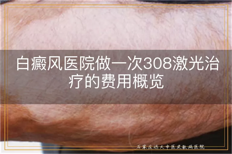 白癜风医院做一次308激光治疗的费用概览