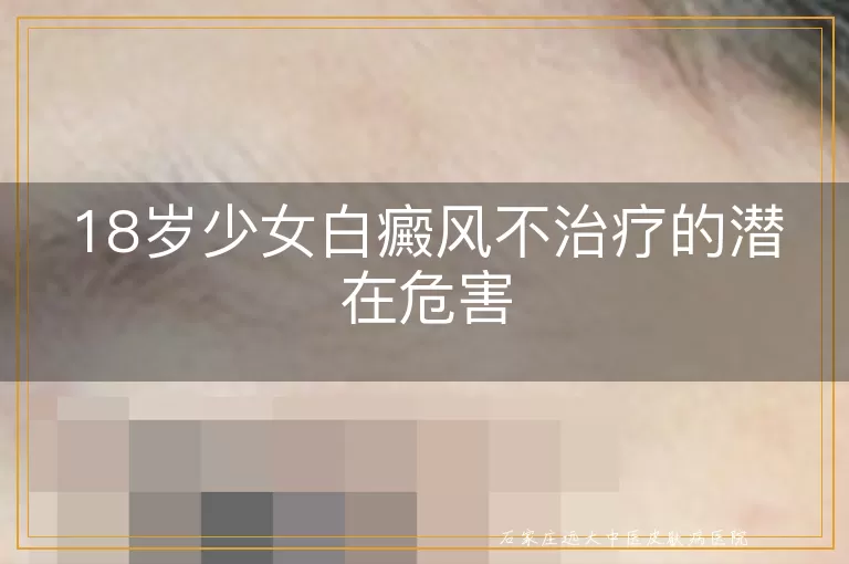 18岁少女白癜风不治疗的潜在危害