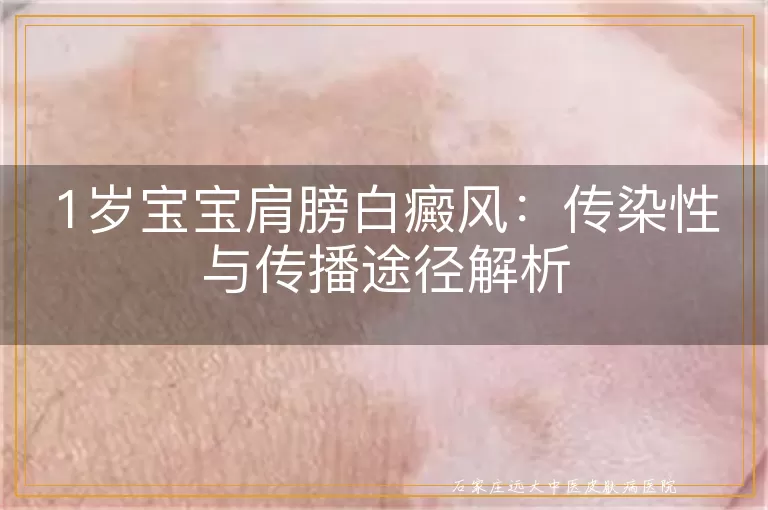 1岁宝宝肩膀白癜风：传染性与传播途径解析