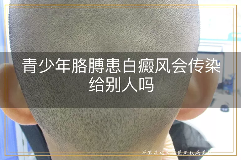 青少年胳膊患白癜风会传染给别人吗