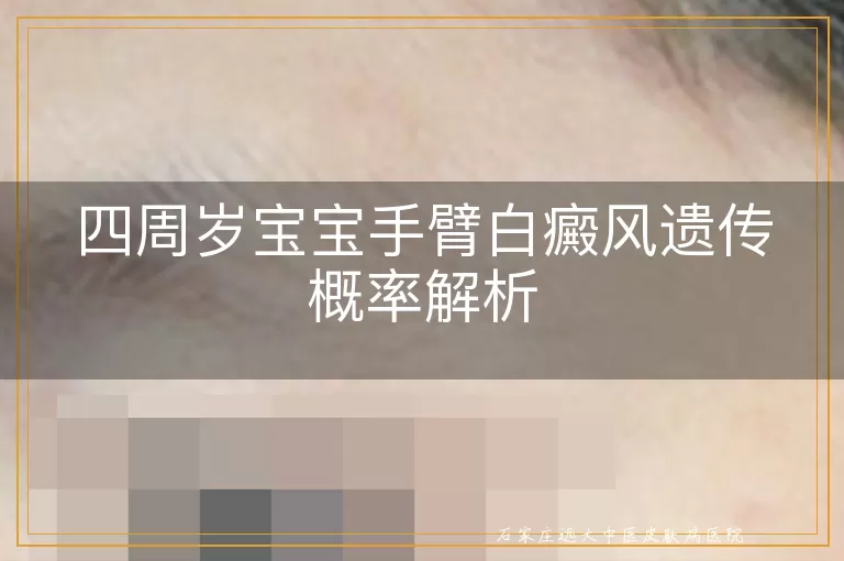 四周岁宝宝手臂白癜风遗传概率解析