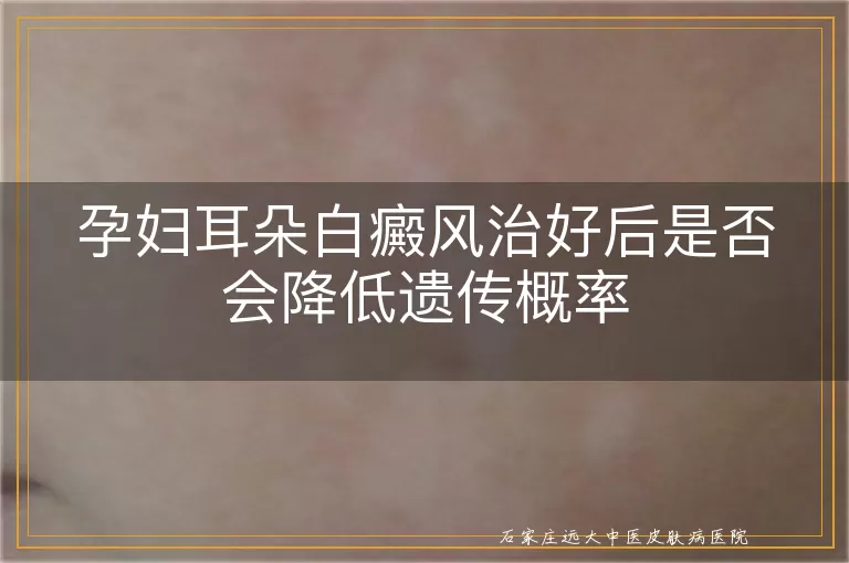 孕妇耳朵白癜风治好后是否会降低遗传概率