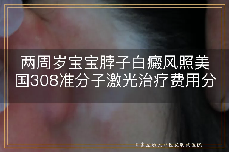 两周岁宝宝脖子白癜风照美国308准分子激光治疗费用分析